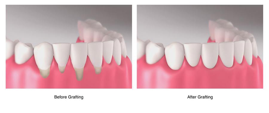illustration of before and after soft tissue grafting